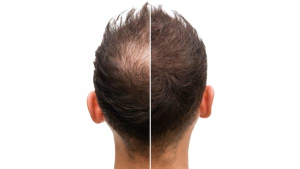 hair_restoration_naperville